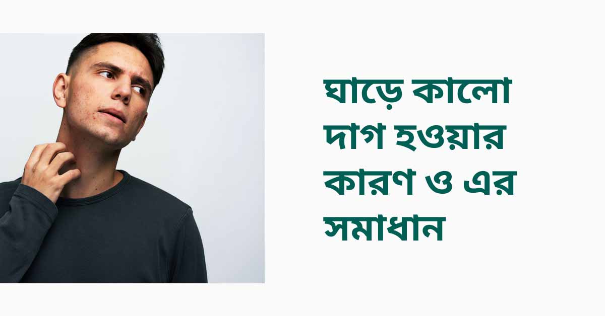 ঘাড়ের কালো দাগ দূর
